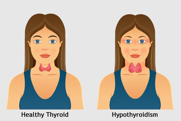 Is Your Thyroid Sabotaging Your Weight-Loss Goals?