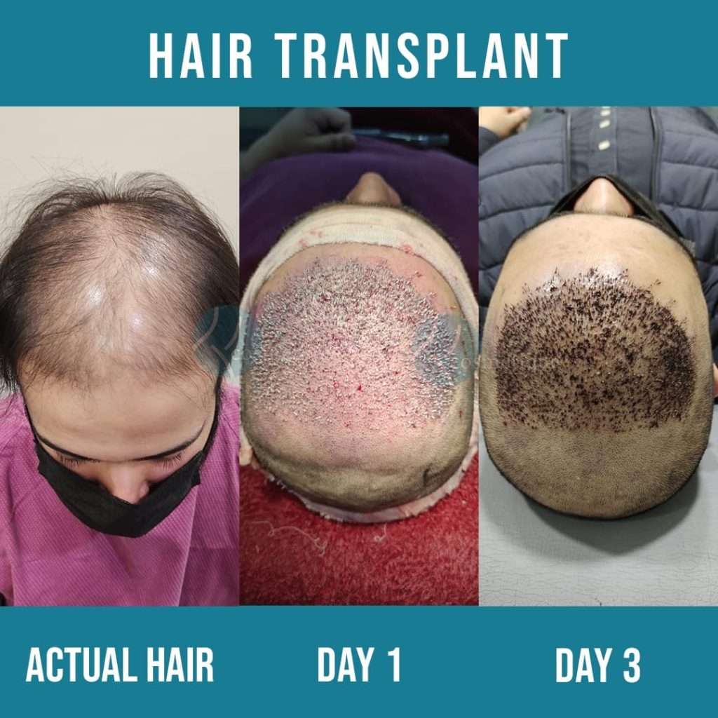 best hair transplant in pakistan