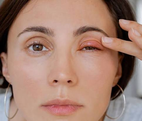 Does Hypochlorous Acid for Styes Really Speed Up Recovery?